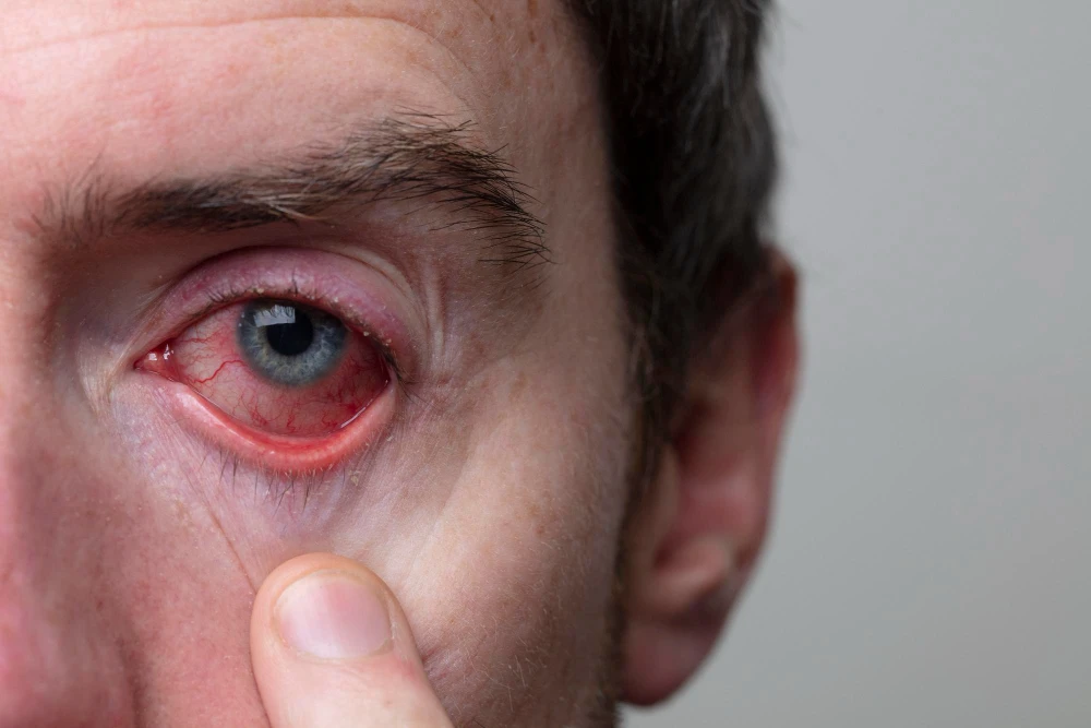 What Can Cause Eye Allergies?