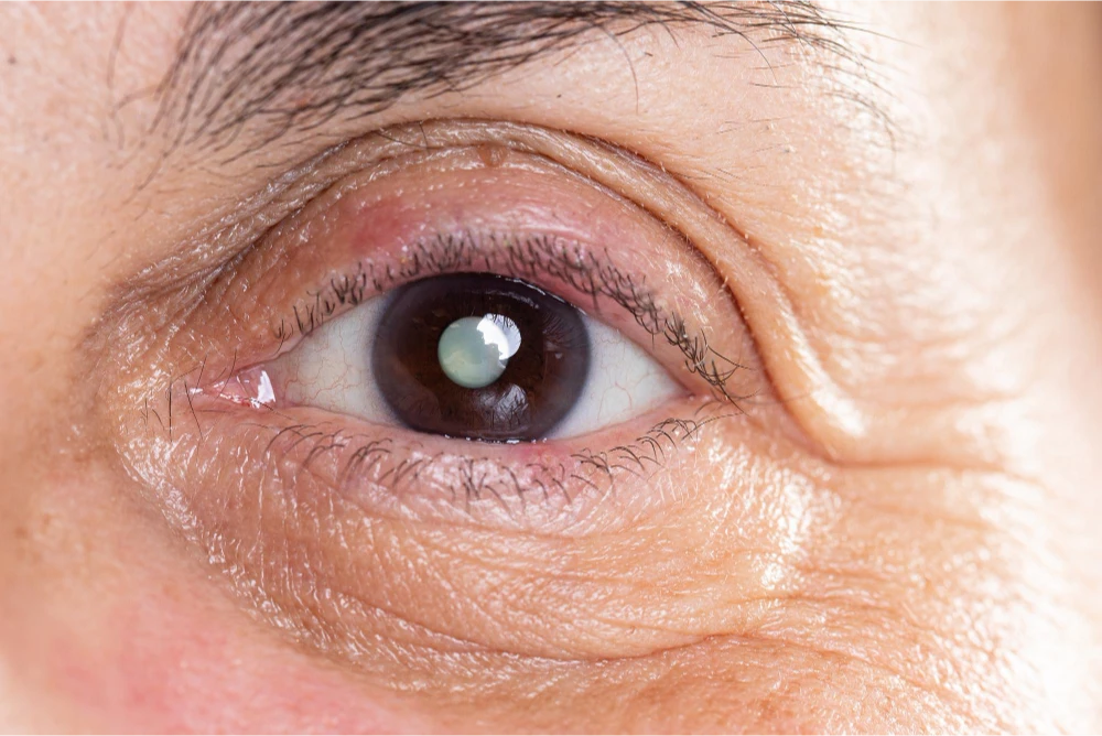 Understanding Cataracts: Causes, Symptoms, and Treatments