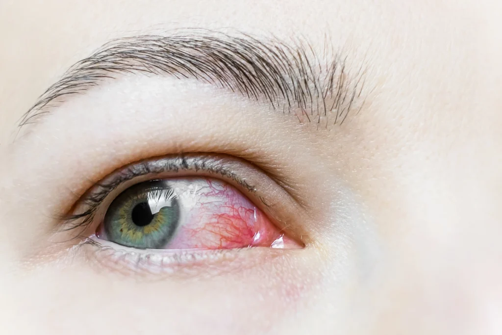 Impact of Environmental Factors on Eye Allergy Symptoms