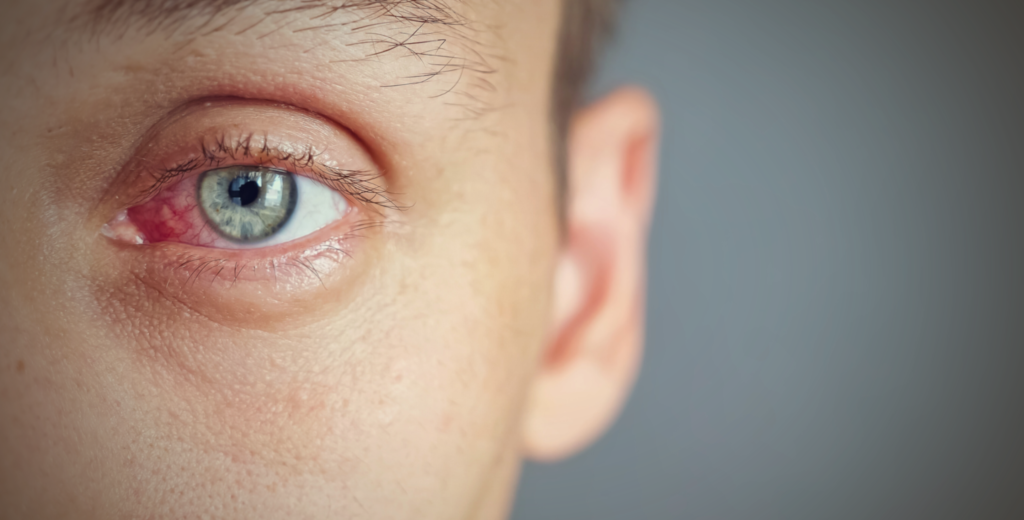 Dry Eyes in Winter: Causes, Treatment, and Prevention