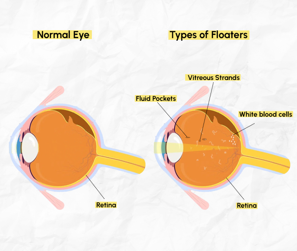 Comparison: Healthy Eye vs Eye With Floaters