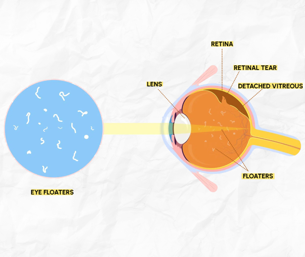 Floaters After Cataract Surgery: Is It Normal?