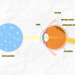 Floaters After Cataract Surgery: Is It Normal?