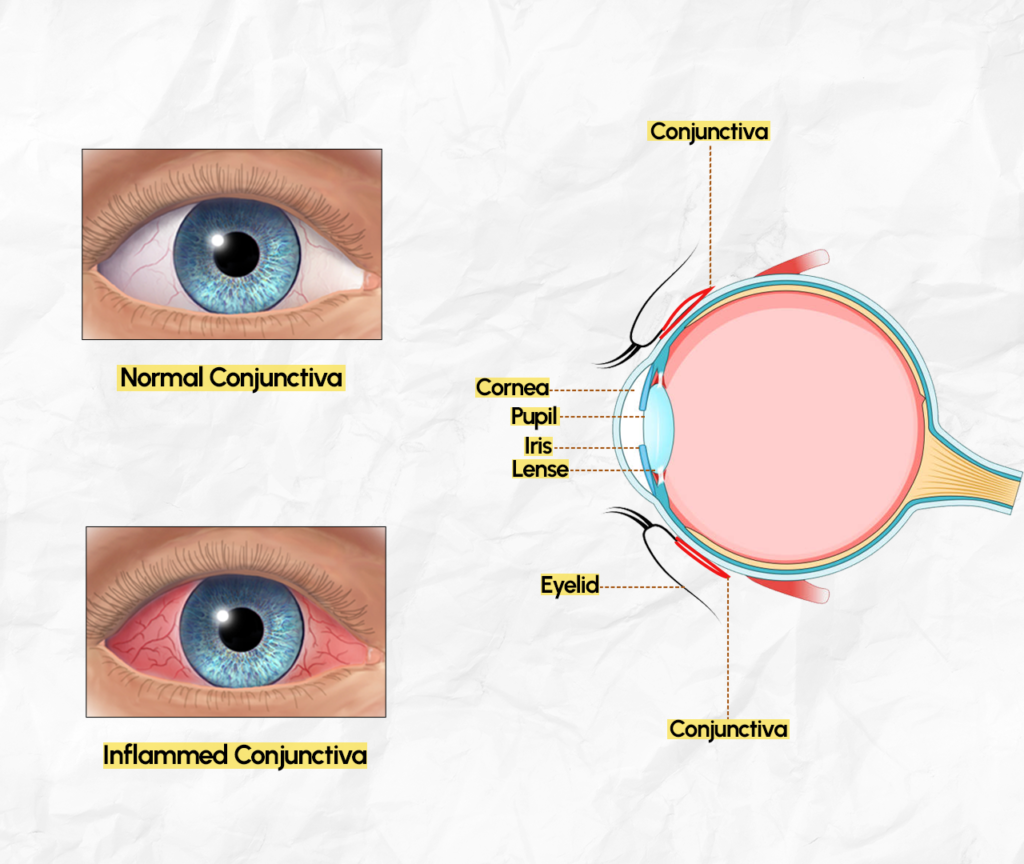 What Are Eye Allergies?