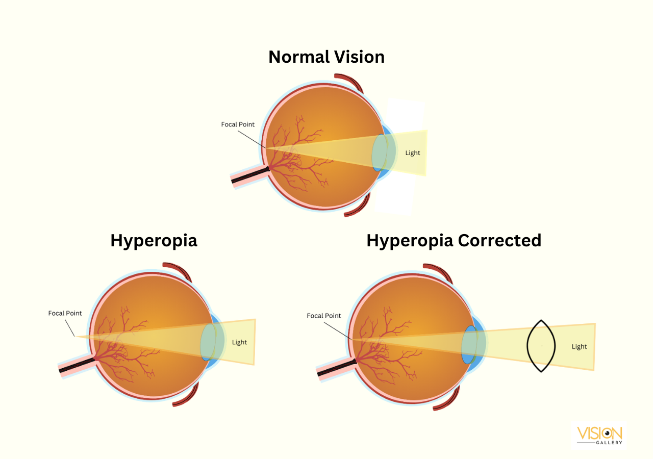 Hyperopia corrected using convex lens