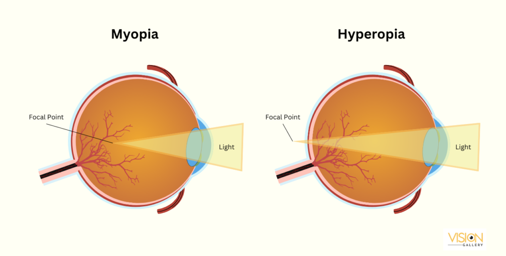 A comparison between myopia and hyperopia