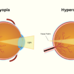 A comparison between myopia and hyperopia