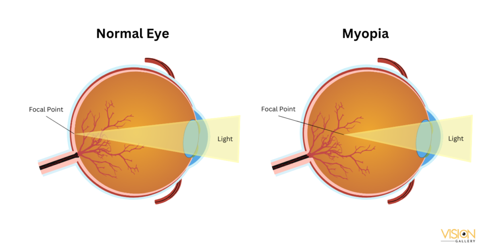 Comparison of a normal eye and an eye with myopia, illustrating differences in vision clarity and focus.