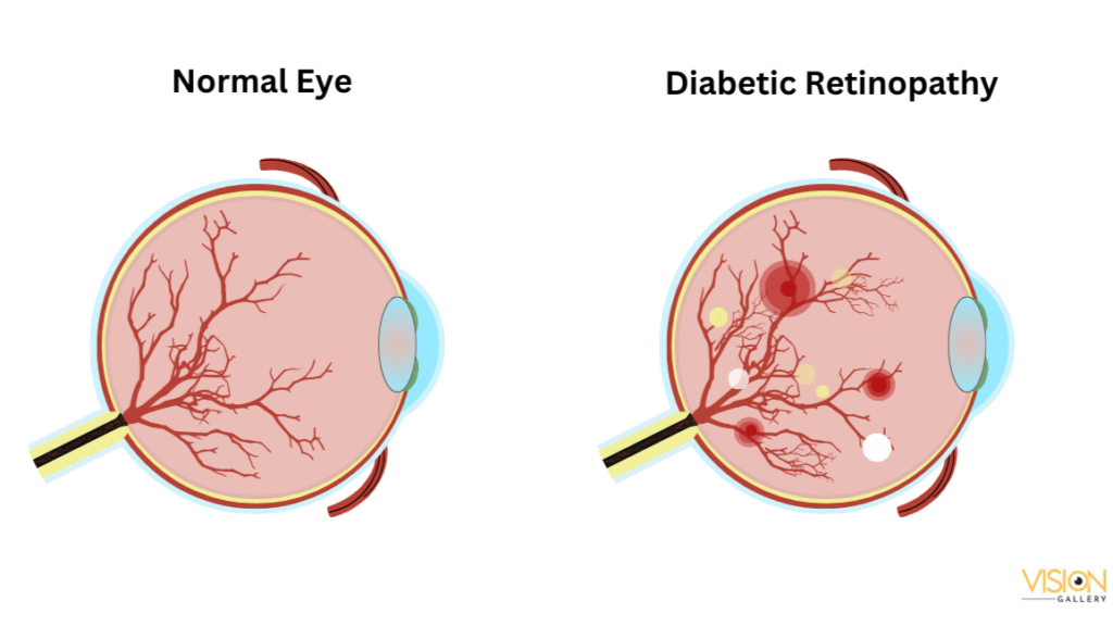 Comparison of a normal eye and an eye affected by diabetic retinopathy and macular edema, highlighting visual impairments.