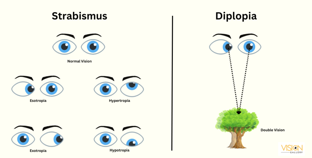 Illustration depicting strabismus and diplopia, highlighting the differences between the two visual disorders