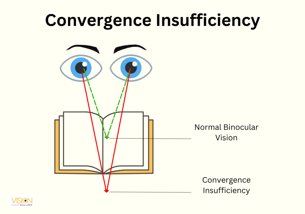 Illustration of convergence insufficiency, showing an eye struggling to focus on a nearby object