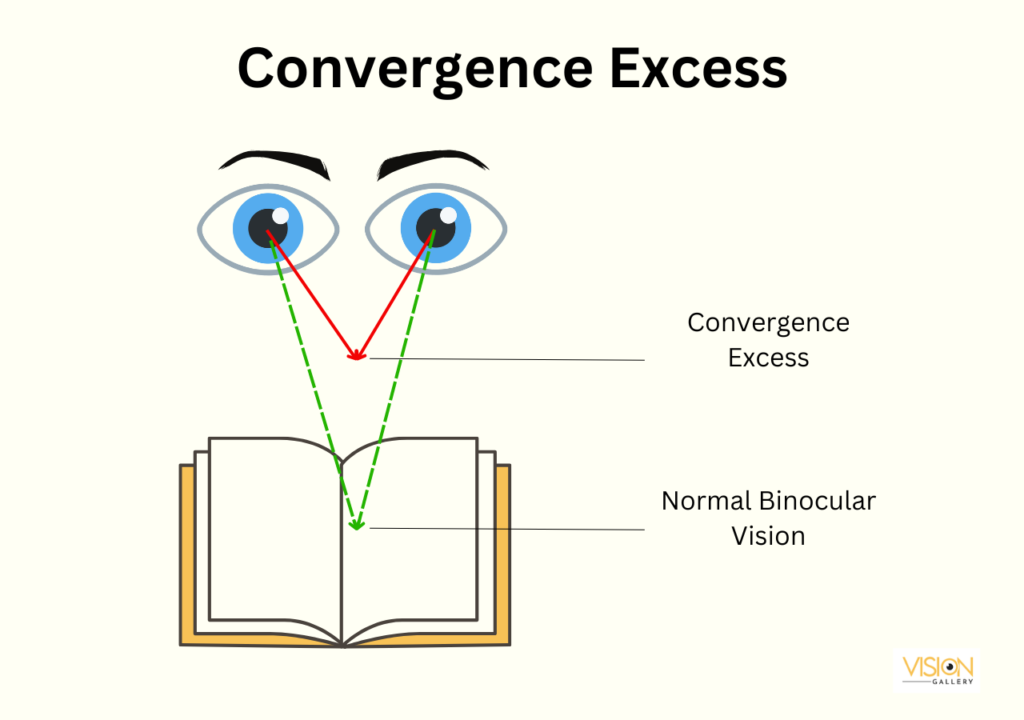 Illustration depicting Convergence Excess, a condition where the eyes are misaligned, affecting visual focus and coordination