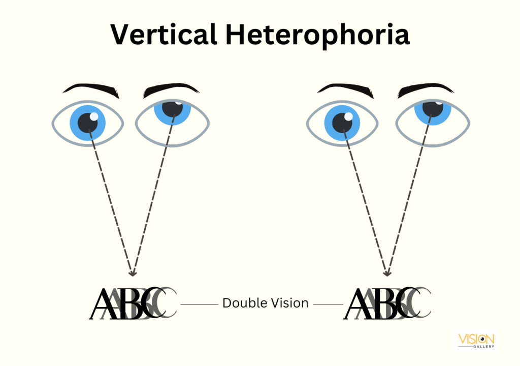 Illustration depicting vertical heptoporia, showcasing the effects of double vision associated with vertical heterophoria