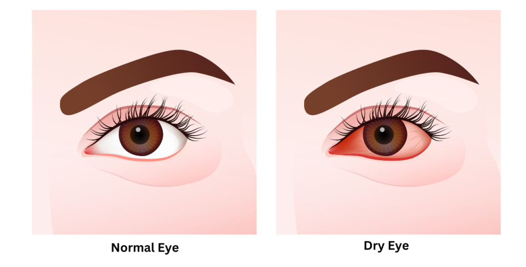 Vector illustration comparing a normal eye and a dry eye, highlighting differences in appearance