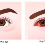 Vector illustration comparing a normal eye and a dry eye, highlighting differences in appearance