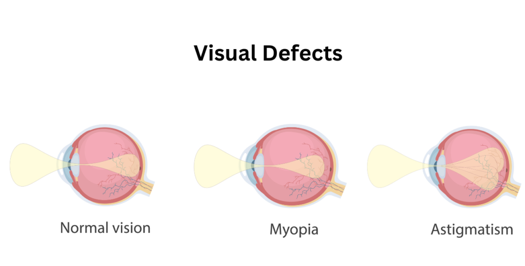 Comparison of normal eye, myopia, and astigmatism, illustrating visual defects and their effects on vision clarity.