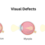 Comparison of normal eye, myopia, and astigmatism, illustrating visual defects and their effects on vision clarity.