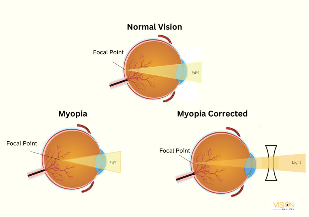 Visual representation contrasting normal vision with myopia and its correction, highlighting clarity improvements.