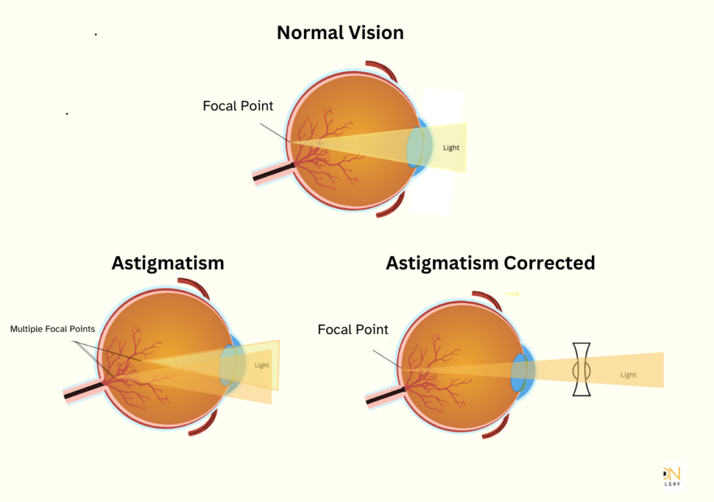 Illustration depicting stages of normal vision, contrasting with astigmatism and methods for its correction.