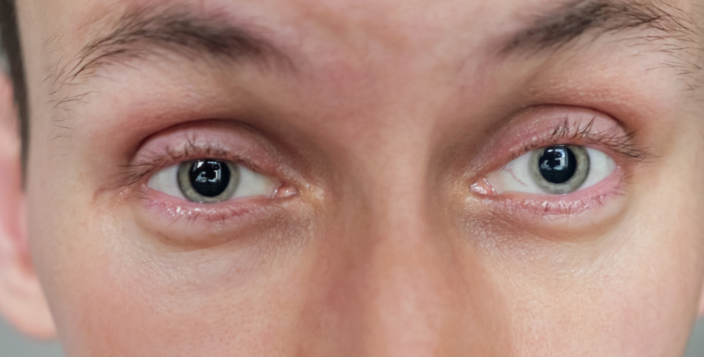 Close-up of a man's eyes showing retracted eyelids due to thyroid eye disease, highlighting the condition's impact on appearance