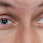 Close-up of a man's eyes showing retracted eyelids due to thyroid eye disease, highlighting the condition's impact on appearance