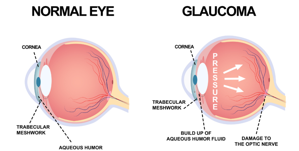 Comparison of a normal eye and an eye affected by glaucoma, highlighting differences in appearance and structure