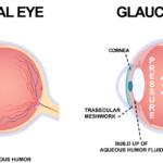 Comparison of a normal eye and an eye affected by glaucoma, highlighting differences in appearance and structure