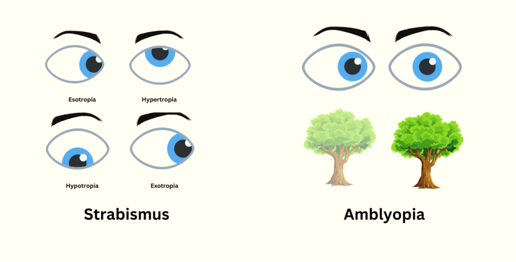 The eyes of an amblyopia patient, emphasizing the distinct visual effects of lazy eye in comparison to various strabismus forms.