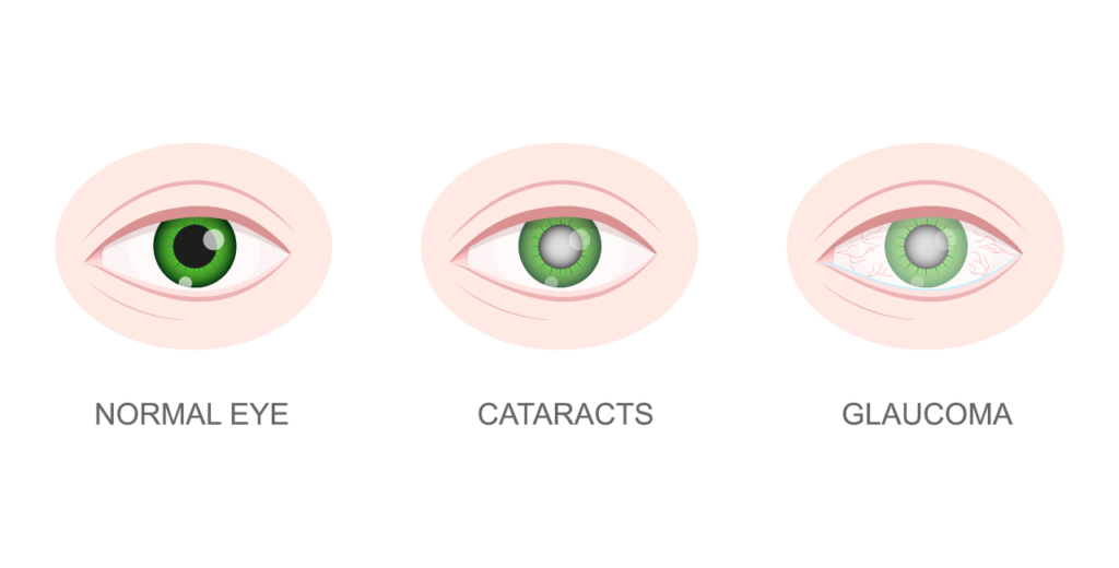 Illustration comparing a normal eye, cataracts, and glaucoma, highlighting the differences in eye health and vision clarity.