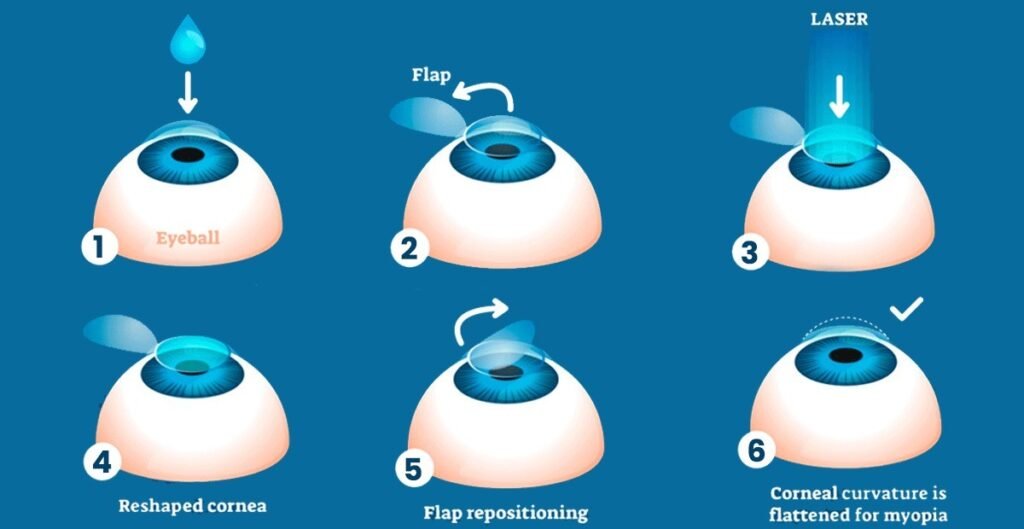 Visual guide illustrating the stages of LASIK eye surgery for correcting astigmatism.