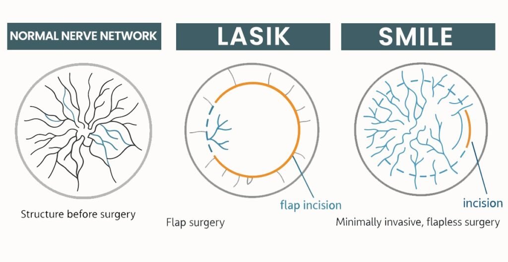 Diagram illustrating the stages of LASIK and SMILE eye surgery procedures for vision correction.