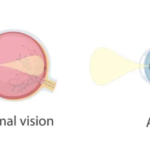 Visual representation showing normal vision versus astigmatism, highlighting the distortion in sight experienced by individuals.