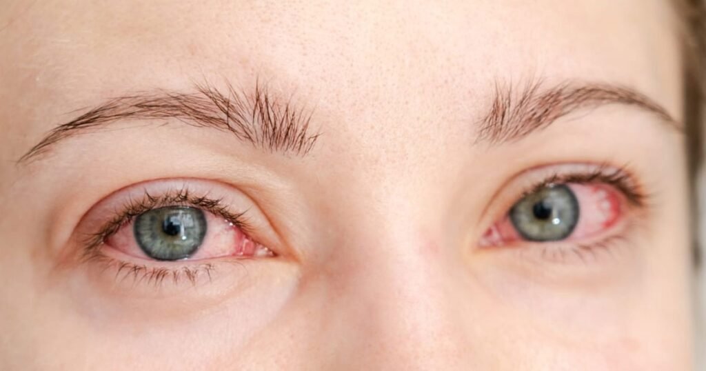 A woman displaying a pink eye condition