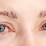 A woman displaying a pink eye condition