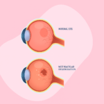 Diagram comparing macular degeneration and age-related macular degeneration, highlighting wet AMD characteristics.