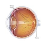 Detailed illustration of the eye's anatomy, highlighting areas relevant to understanding eye floaters and their implications.