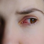 A woman with red eyes, highlighting symptoms of itchy eyes and discussing common causes and relief tips.