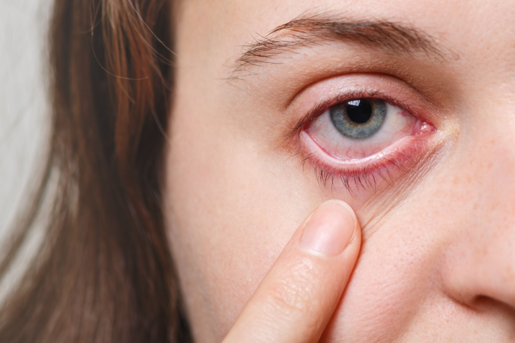 Close-up of a red, irritated eye with dryness and visible blood vessels.