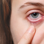Close-up of a red, irritated eye with dryness and visible blood vessels.