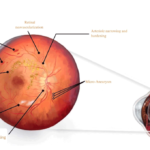 Medical illustration of hypertensive retinopathy showing retinal damage, hemorrhages, and swelling.