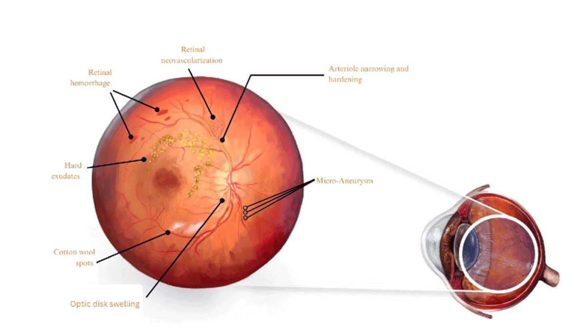 Medical illustration of hypertensive retinopathy showing retinal damage, hemorrhages, and swelling.