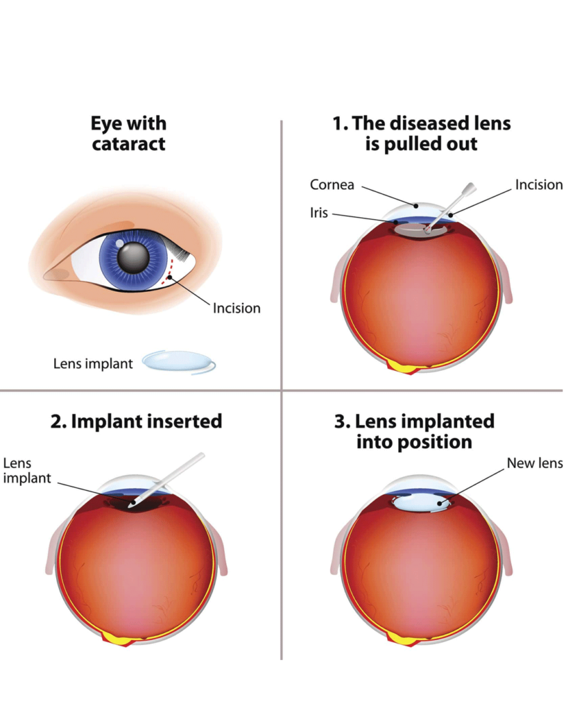 Diagram illustrating the stages of an eye affected by cataracts, part of a step-by-step timeline for cataract surgery.