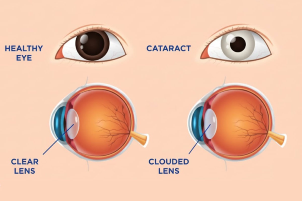 Illustration showing the different stages of the eye, relevant to understanding cataract surgery duration.