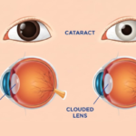 Illustration showing the different stages of the eye, relevant to understanding cataract surgery duration.