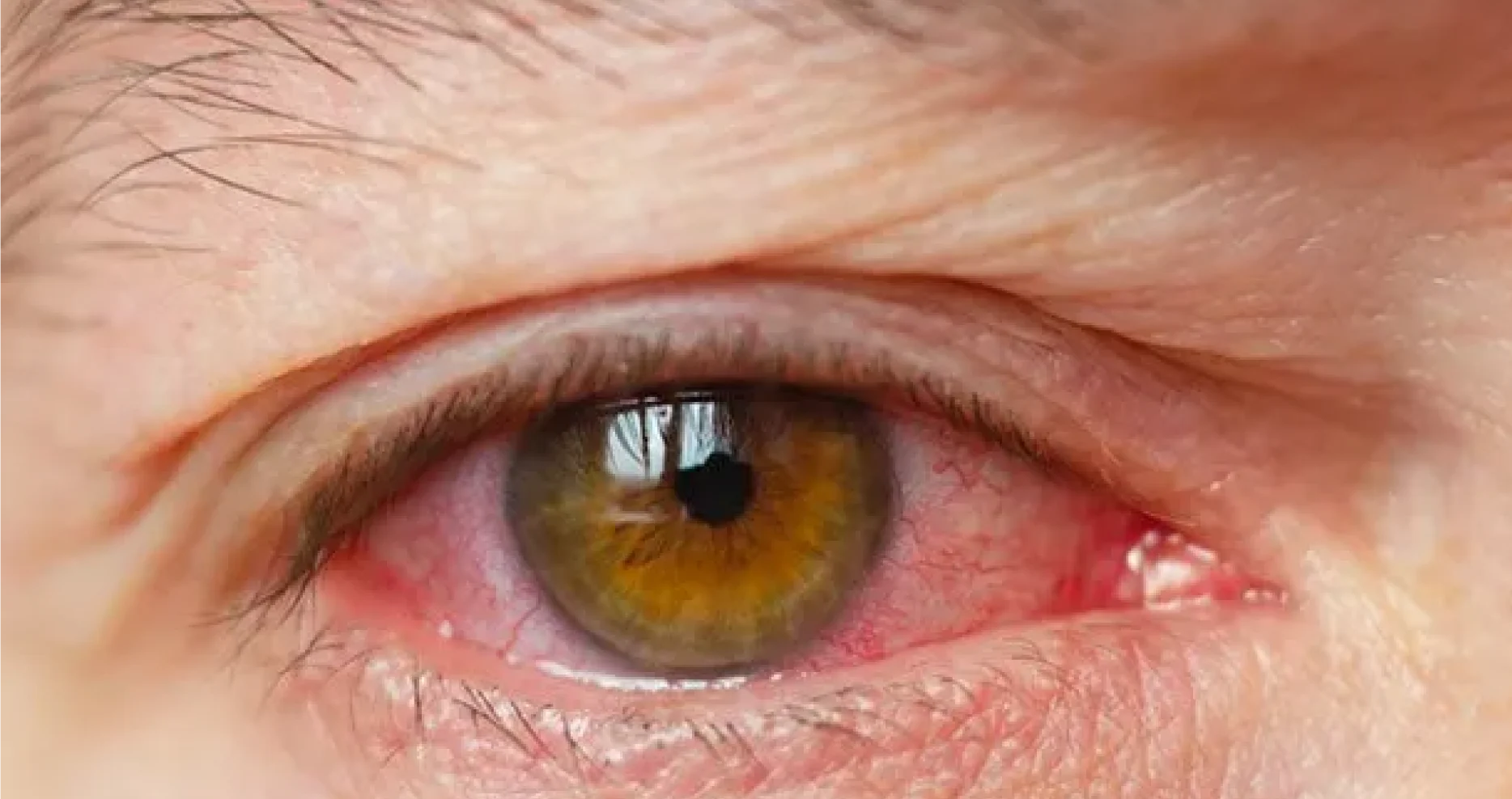 Dry Eyes Specialist in Katy, TX