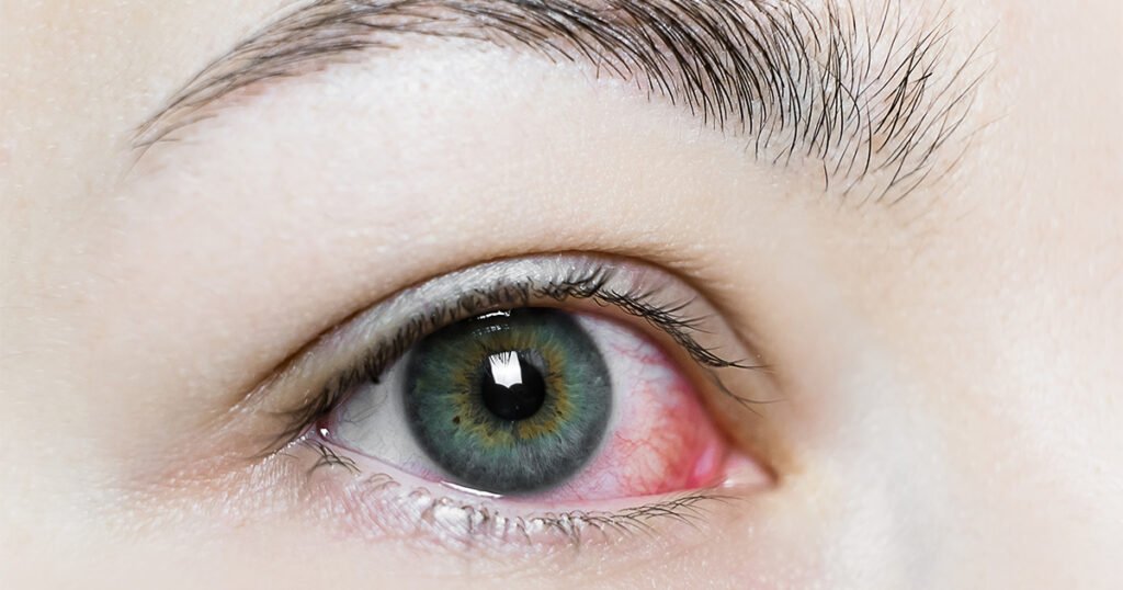 Detailed view of a woman's eye with red and pink discoloration, representing a scratched eye and tips for overnight healing.