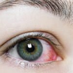 Detailed view of a woman's eye with red and pink discoloration, representing a scratched eye and tips for overnight healing.