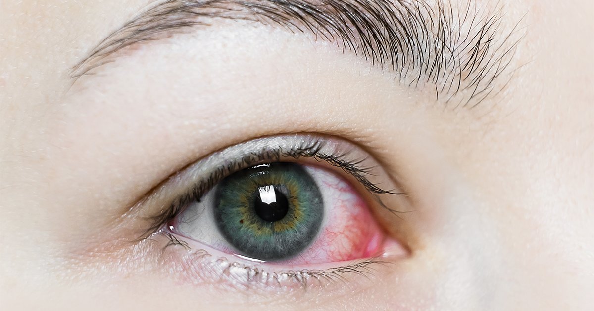 Detailed view of a woman's eye with red and pink discoloration, representing a scratched eye and tips for overnight healing.
