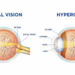 Visual representation of normal vision alongside hyperopia, highlighting the lenses that correct hyperopia.