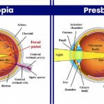 Two diagrams illustrating the anatomy of the eye, highlighting differences between presbyopia and myopia.